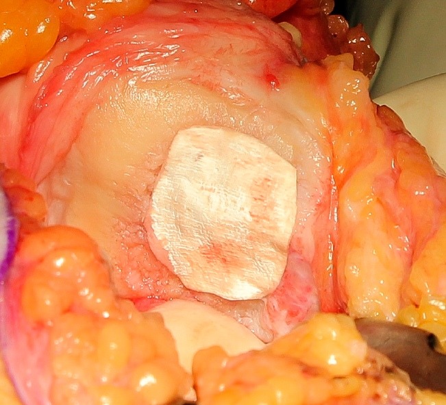 Riparazione delle lesioni della cartilagine della rotula con tecnica AMIC